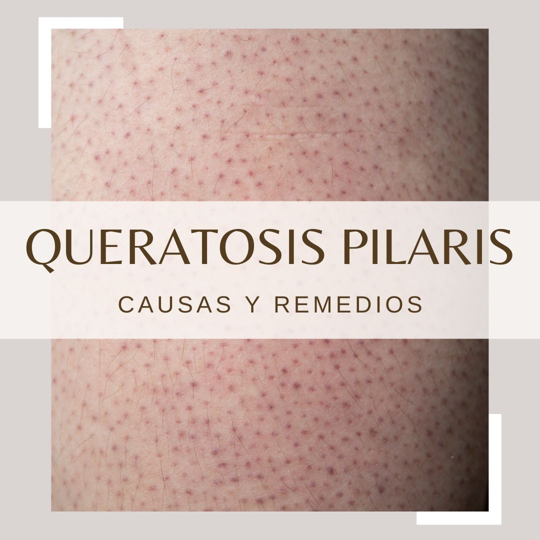 Granitos En Los Brazos Queratosis Pilaris Sin Siliconas